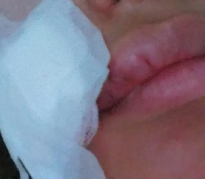 Brasil: ladrón mordió a turista paraguaya en la cara y le provocó herida de 14 puntos