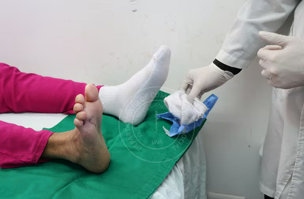 Tratamiento con larvas de mosca evita mutilación del pie de paciente diabética