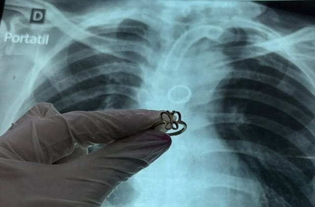 Hallan anillo en el pulmón de paciente con traqueotomía y desconocen cómo llegó allí