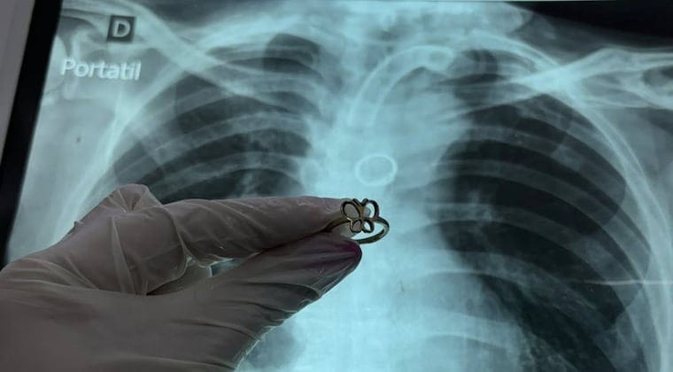 Hallan anillo en el pulmón de paciente con traqueotomía y desconocen cómo llegó allí