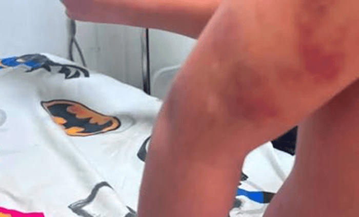 Imputan a la madre y padrastro de niña con TEA que fue brutalmente agredida en PJC Imputan a la madre y padrastro de niña con TEA que fue brutalmente agredida en PJC